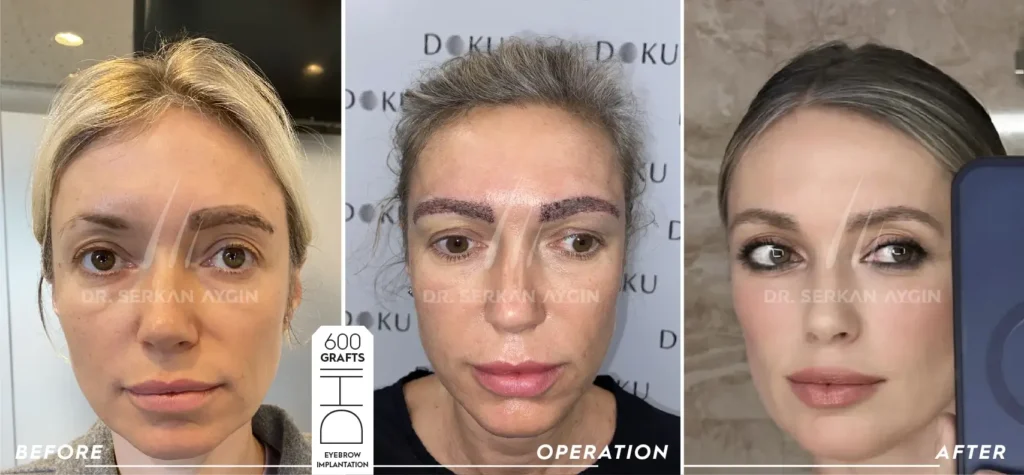 brows transplant before and after