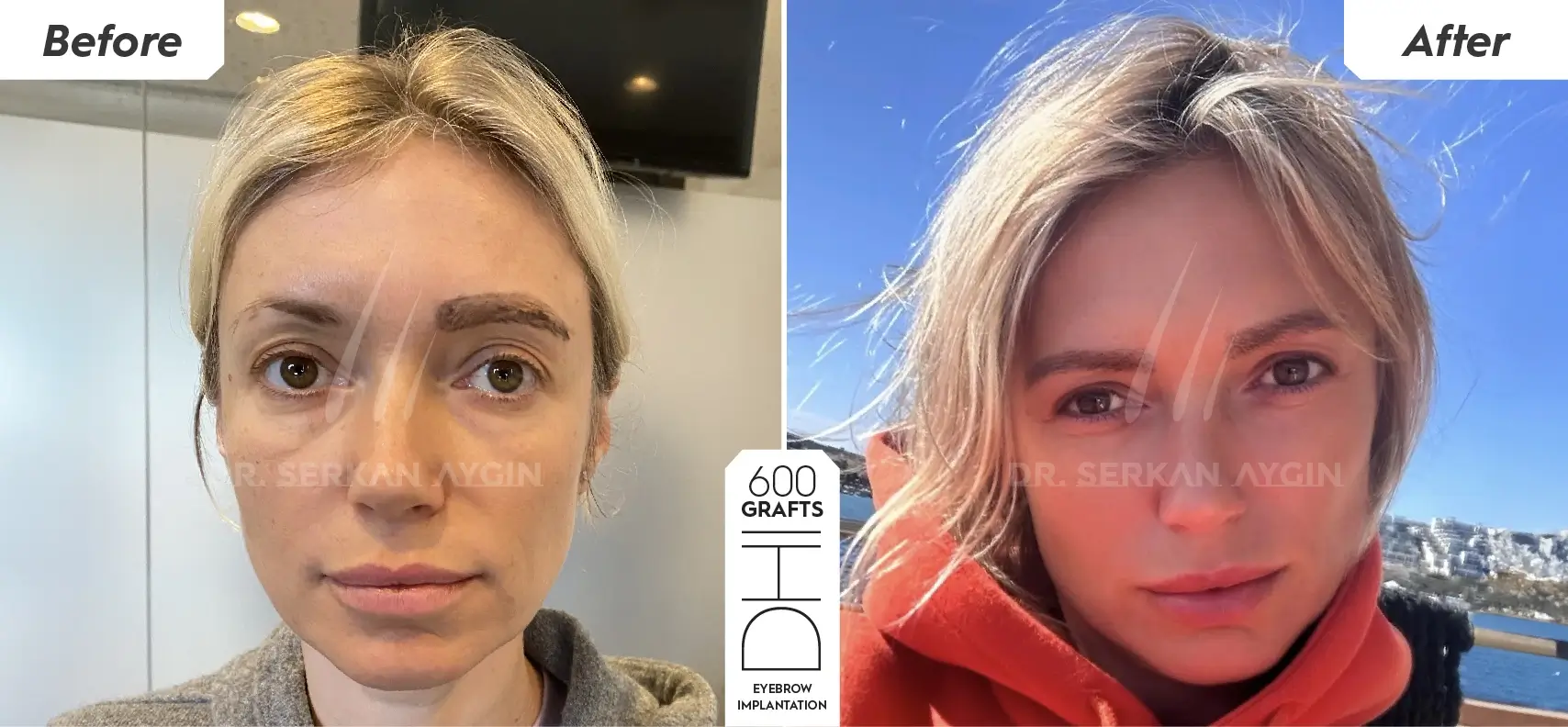 brows transplant before and after