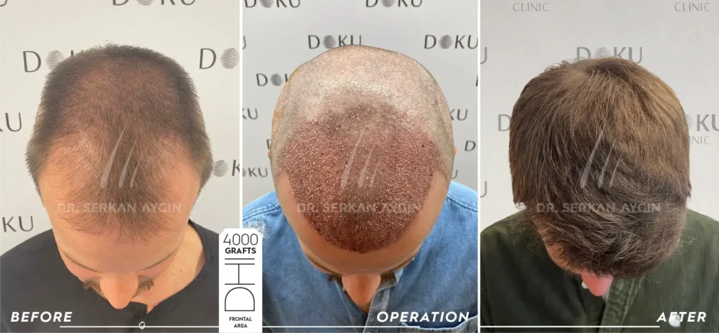 before and after 4000