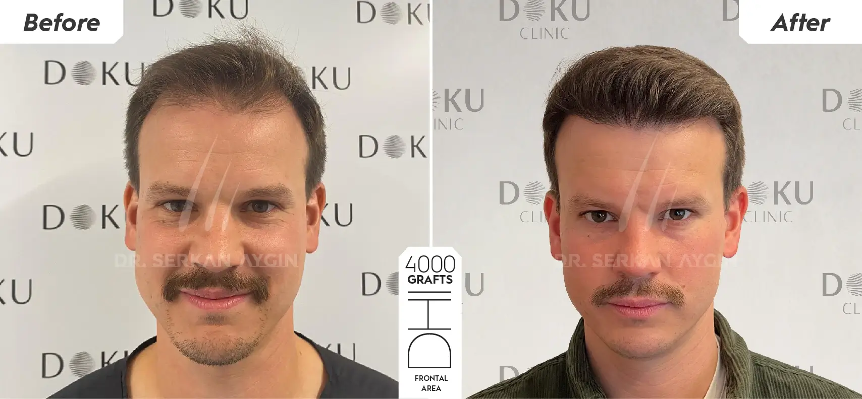 before and after 4000