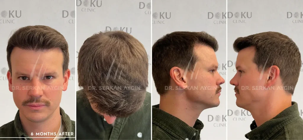 before and after 4000