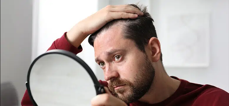 Erkek tipi saç dökülmesinin yaygın belirtileri (ön çizgi, şakak ve tepe seyrelmesi)