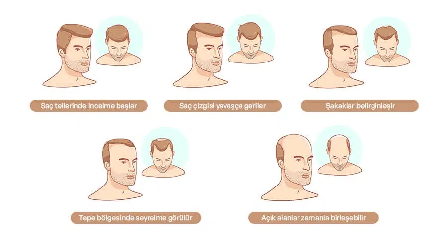 Erkek tipi saç dökülmesinin başlangıcı ve ilerleme süreci