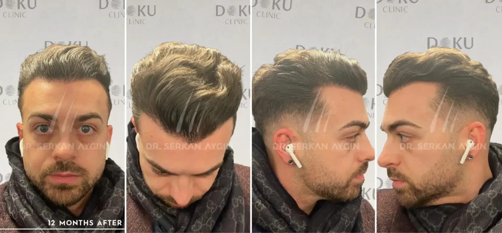 DANIEL 2800 before and after