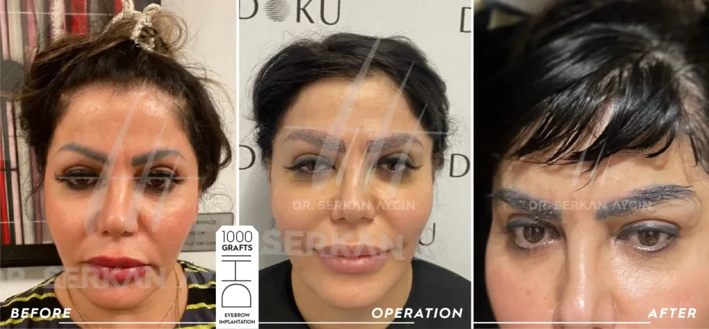 1000 eyebrow transplant