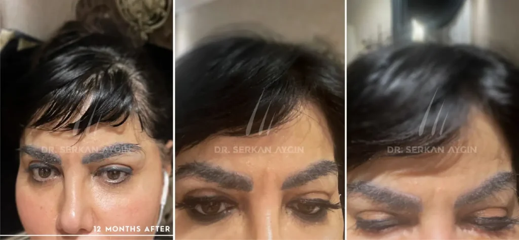 1000 eyebrow transplant